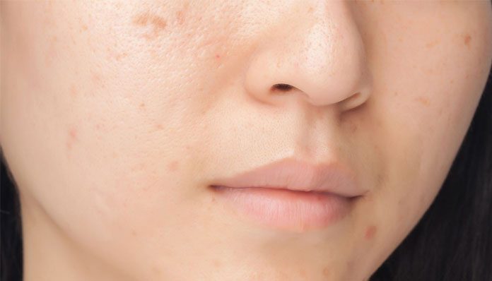 best pimple marks removal cream for face and skin